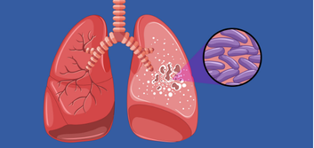 Medical illustration of human lungs with a circular inset showing purple bacteria, on a blue background.